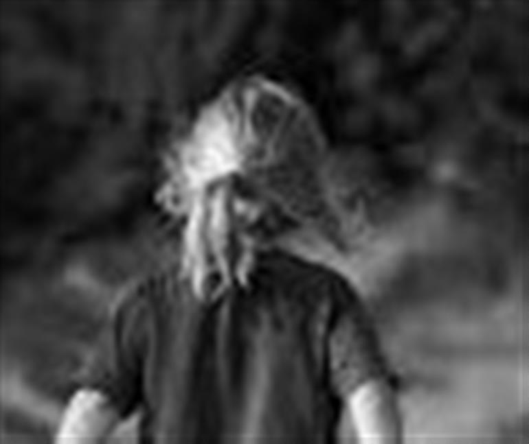 3-Year-Old Girl Suffers Severe Burns While Playing With Matchstick in Ludhiana