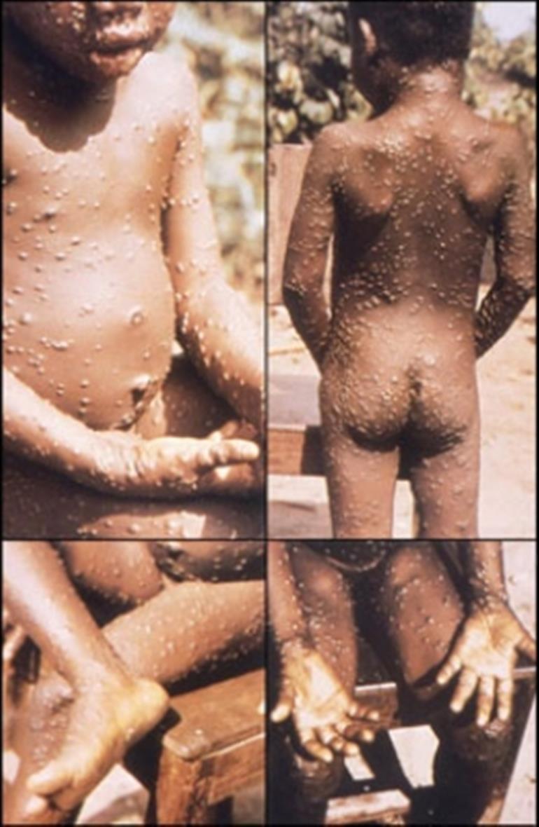 Monkeypox virus detected in Portugal less aggressive, researcher says