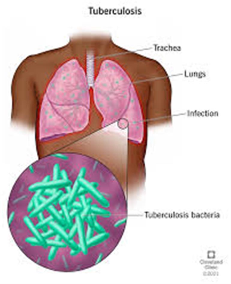 Haryana launches 90-day Intensified Case Finding Campaign for TB Elimination