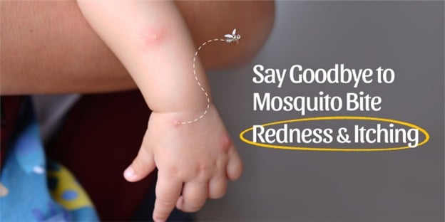 Handy Solution for Mosquito Bites: Parents’ Quick Fix Guide