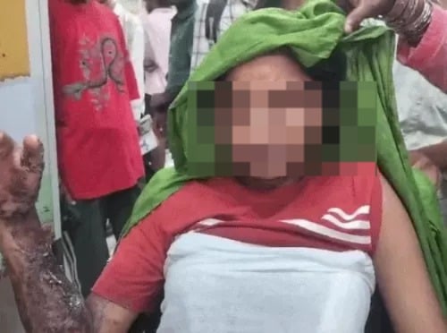 Woman alleges stepparents poured boiling water on her over forced marriage in Faridabad